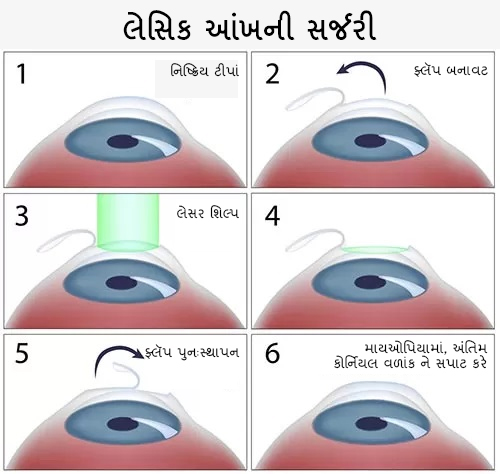લેસિક સર્જરીના ફાયદા, સુધારેલ દ્રષ્ટિ, ચશ્મા અથવા કોન્ટેક્ટ લેન્સથી મુક્તિ માટે લક્ષ્મી આંખની હોસ્પિટલ સાથે નવી મુંબઈ, પનવેલ, ખારઘર, કામોથે અને ડોમ્બિવલી ખાતેના કેન્દ્રોમાં.