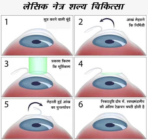 लेसिक सर्जरी के लाभ,  बेहतर दृष्टि, चश्मे या कॉन्टैक्ट लेंस से मुक्ति के लिए,  नवी मुंबई के लक्ष्मी आई हॉस्पिटल, पनवेल, खारघर, कामोठे और डोंबिवली में
