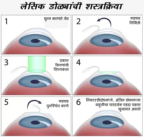 लॅसिक शस्त्रक्रियेचे फायदे, दृष्टी सुधारण्यासाठी, चष्मा किंवा कॉन्टॅक्ट लेन्सपासून मुक्त होण्यासाठी, नवी मुंबईतील लक्ष्मी आय हॉस्पिटलमध्ये, पनवेल, खारघर, कामोठे आणि डोंबिवली येथे
