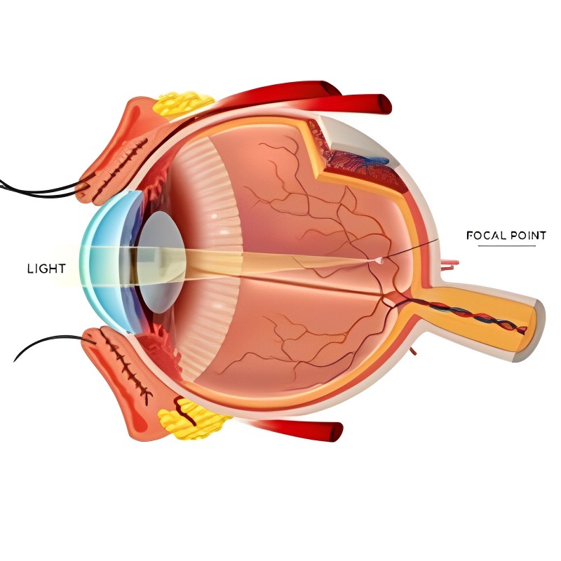 Bladeless LASIK Surgery at Laxmi Eye Hospitals and Institute in Navi Mumbai, centres at Panvel, Kharghar, Kamothe and Dombivali.