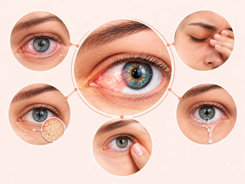Symptoms of Pterygium
