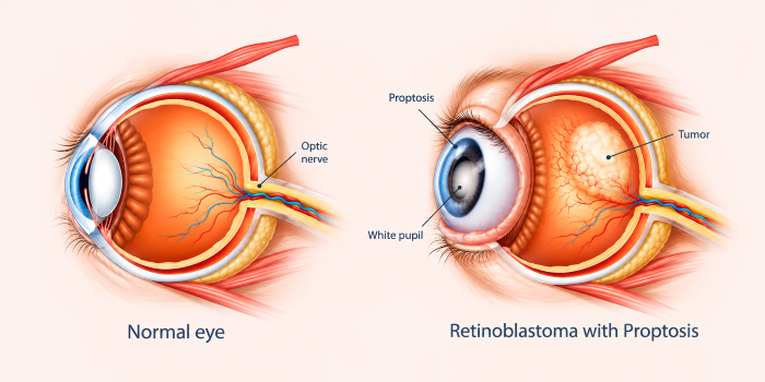 Symptoms of Retinoblastoma Proptosis
