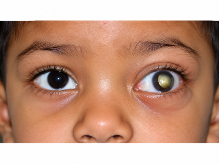 Retinoblastoma Proptosis Treatment in Mumbai & Navi Mumbai at Laxmi Eye Hospital