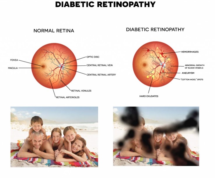 Diabetic Retinopathy at Laxmi Eye Hospitals and Institute in Navi Mumbai, best eye care centres at Panvel, Kharghar, Kamothe and Dombivali.