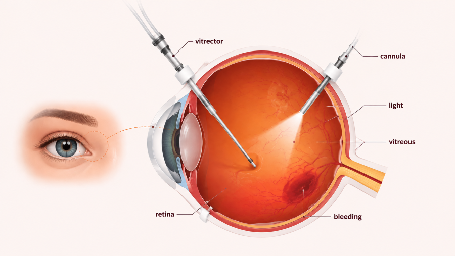 Vitrectomy Surgery
